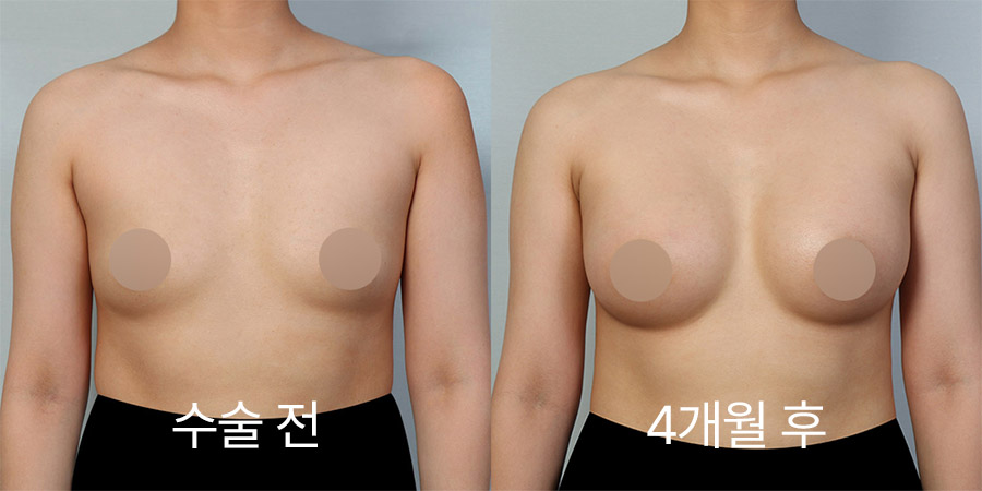 Breast Surgery b&a photo