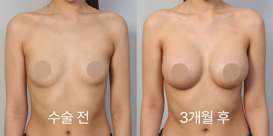 Breast Surgery b&a photo