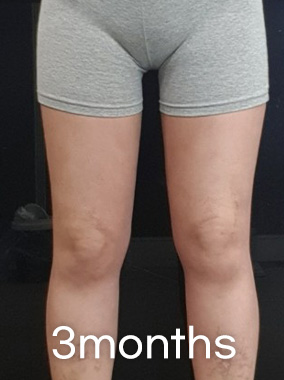 Thigh Liposuction b&a photo