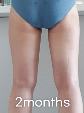 Thigh Liposuction b&a photo