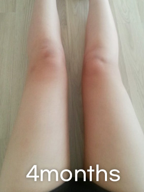 Thigh Liposuction b&a photo