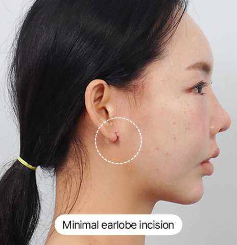 Scar Experiment Jawline Mini Lifting After 24 hours Photos