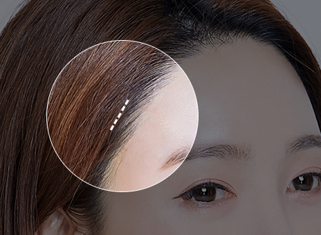 STEP 01 Minimal incision is made in the scalp (1~2 cm)