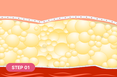 Excessively thick fat layer