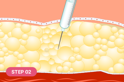 Contouring injection administered into the area