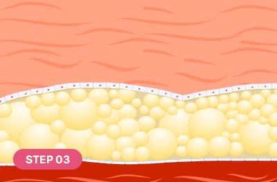 Fat cells broken down and discharged outside the body