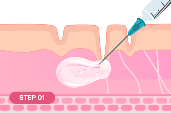 The PLA component promotes collagen production as it breaks down STEP 01