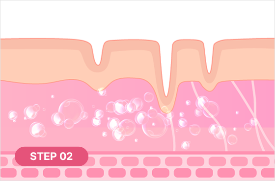 The PLA component promotes collagen production as it breaks down STEP 02