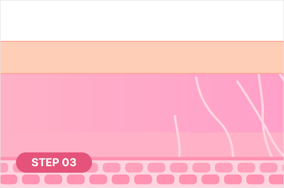 The PLA component promotes collagen production as it breaks down STEP 03