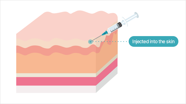 Botox is injected into the skin, not the muscles Reduces fine wrinkles and redness, improves skin texture, and shrinks pore shrinkage among other effects