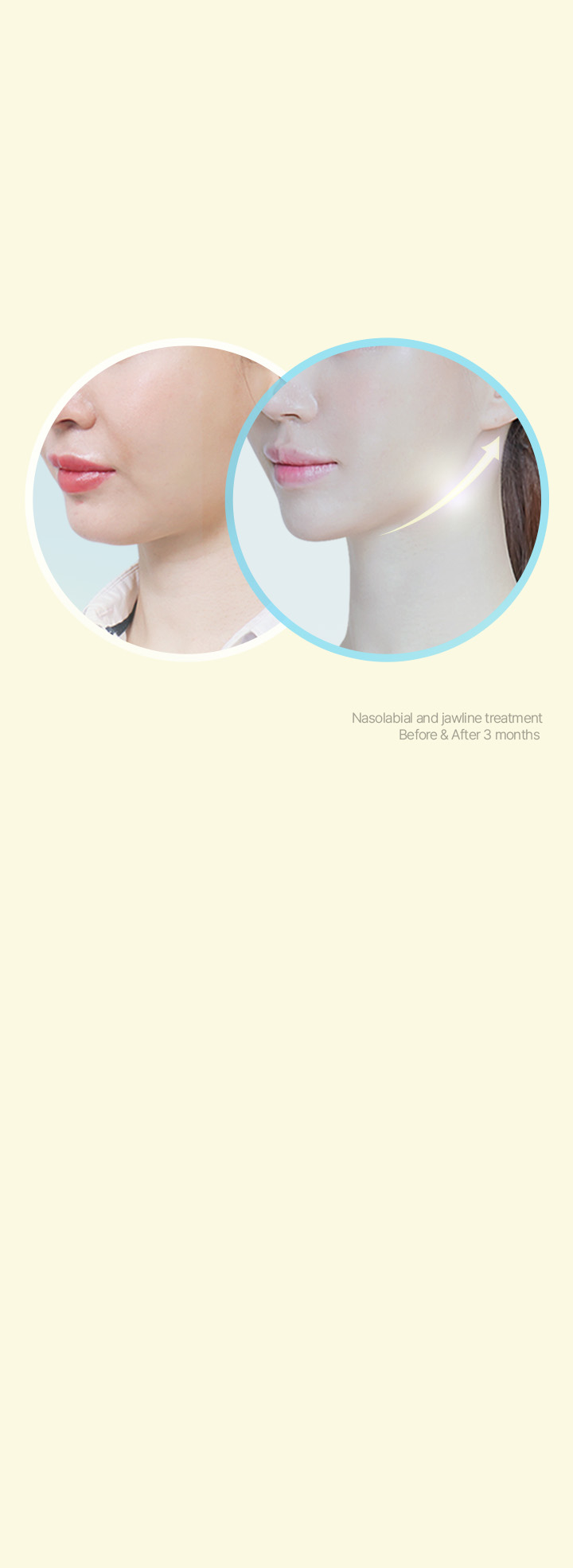 Want to achieve the effect of a facelift with a simpler procedure? We recommended Power MINT Lift with confidence! 